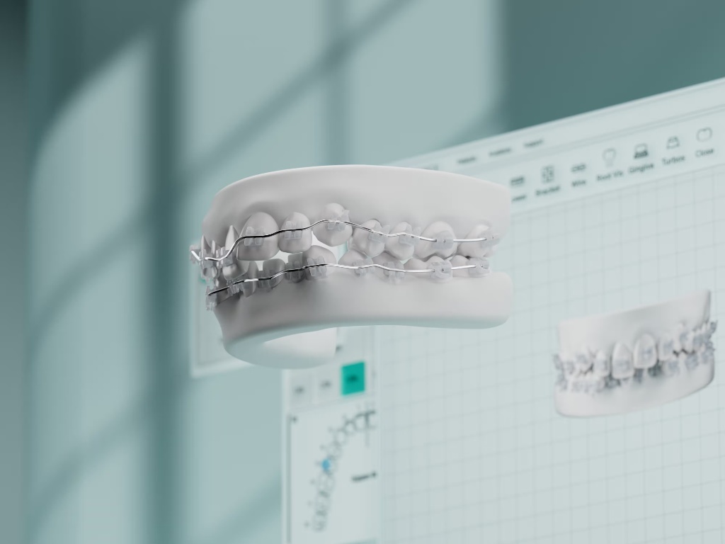 self-ligating braces